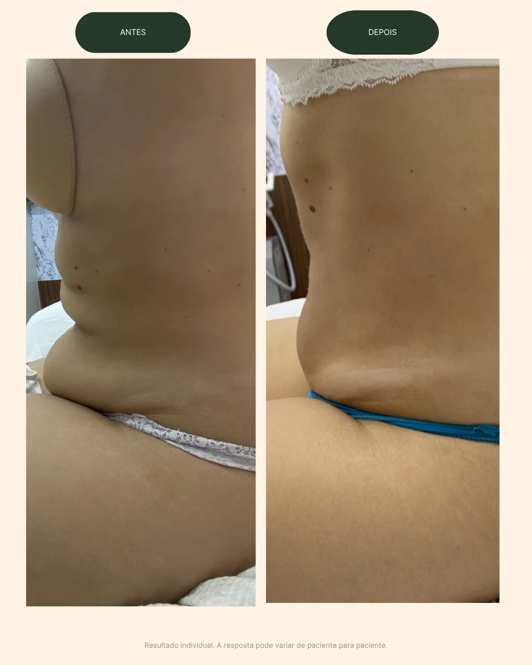 Resultado antes e depois do Método Body Ice na Baumi Clínica em Cascavel.